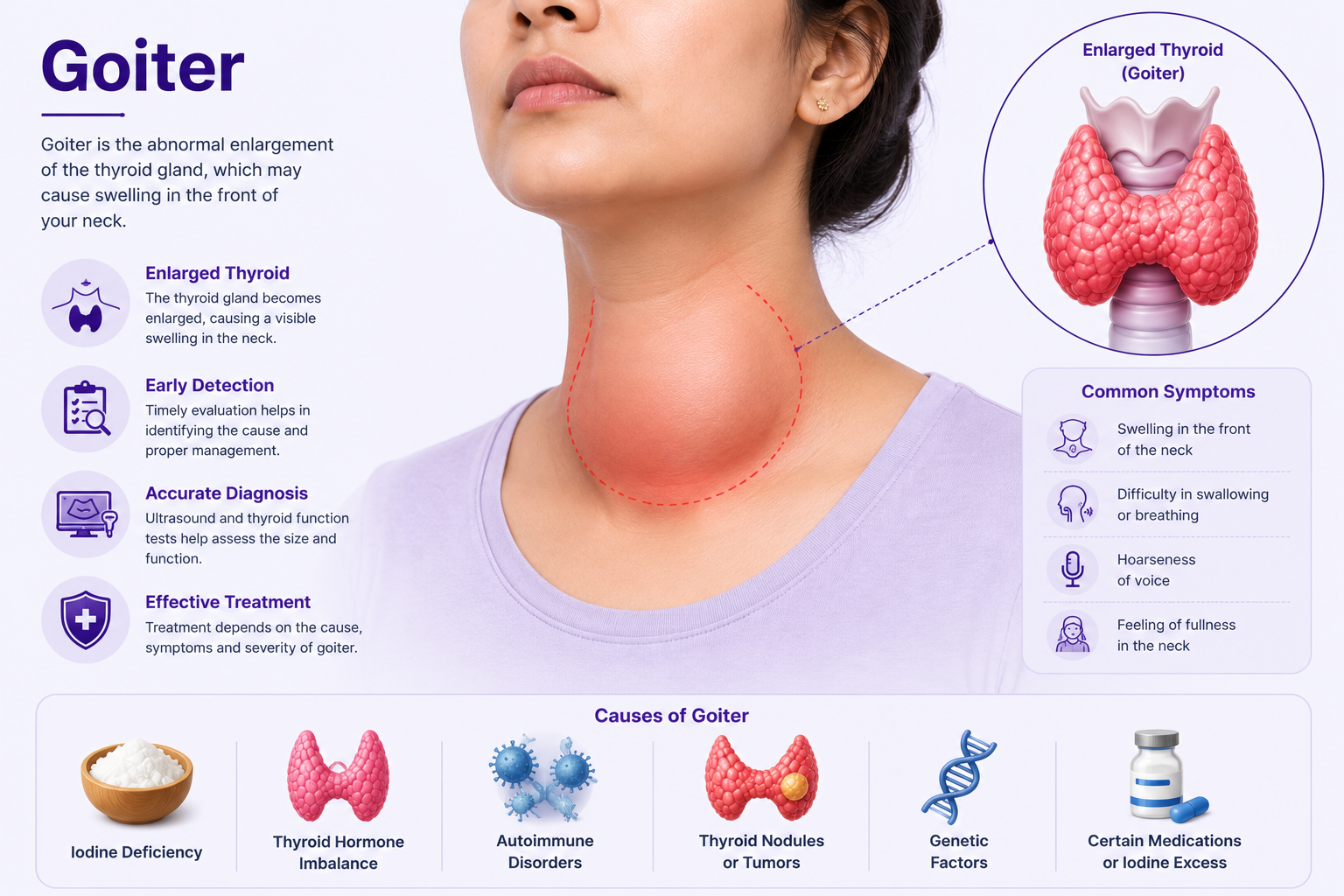 Goiter treatment