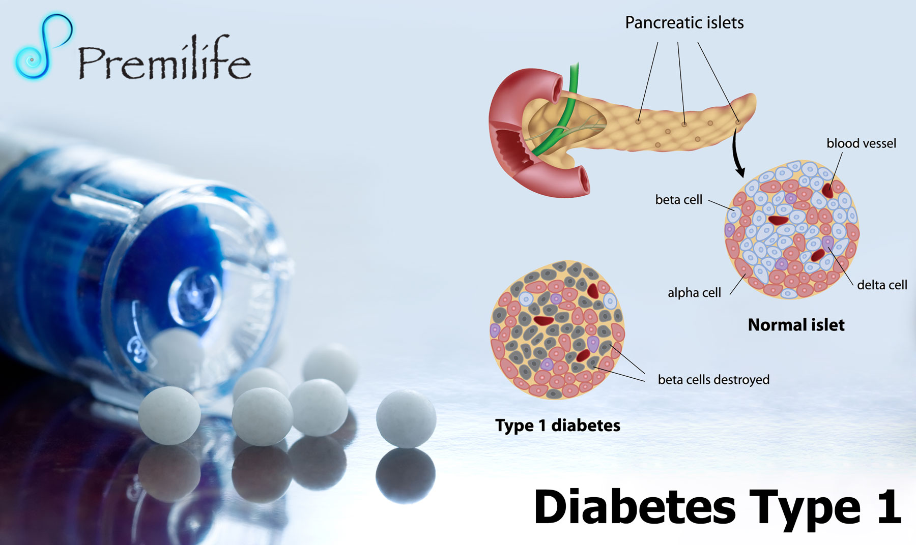 Type 1 diabetes treatment options