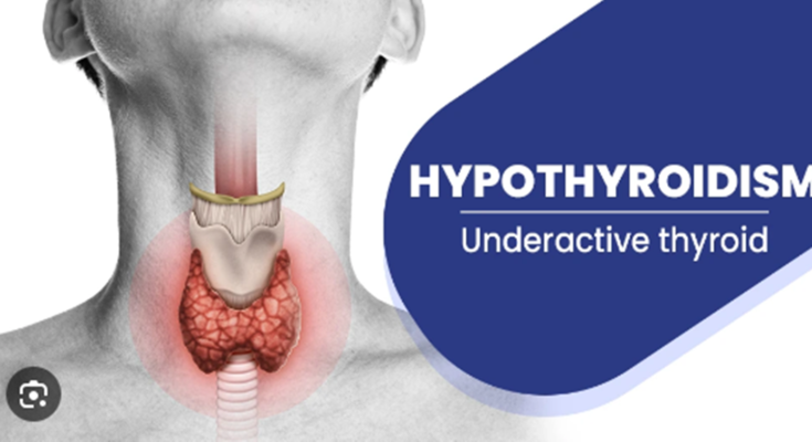 Hypothyroidism underactive thyroid